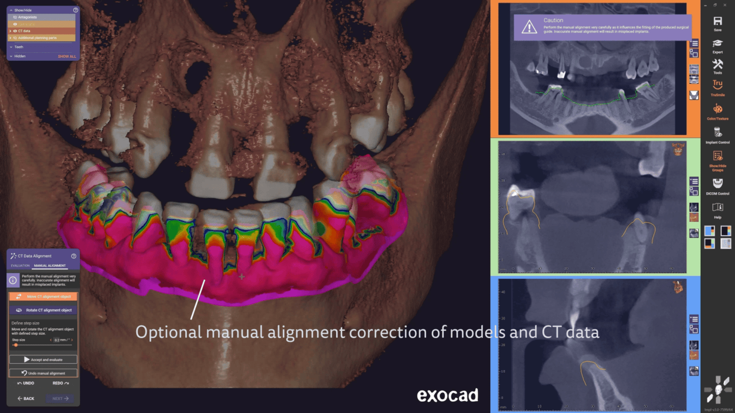 Exocad 9036 AI + partialCad 3.2 gratuit
