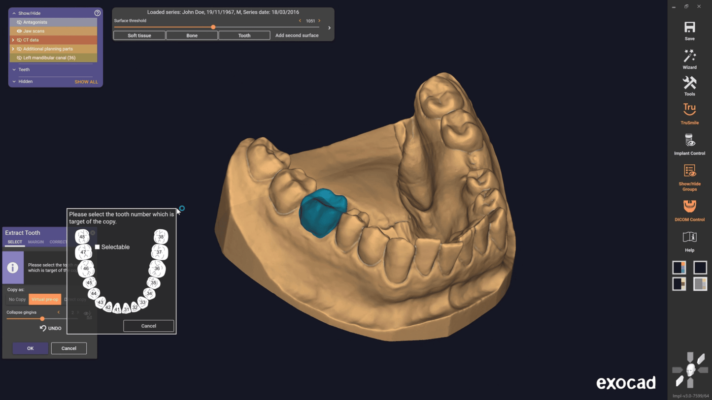 Exocad 9036 AI + partialCad 3.2 gratuit