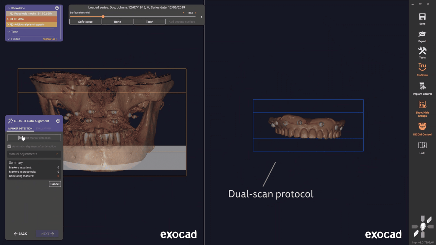 Exocad 9036 AI + partialCad 3.2 gratuit