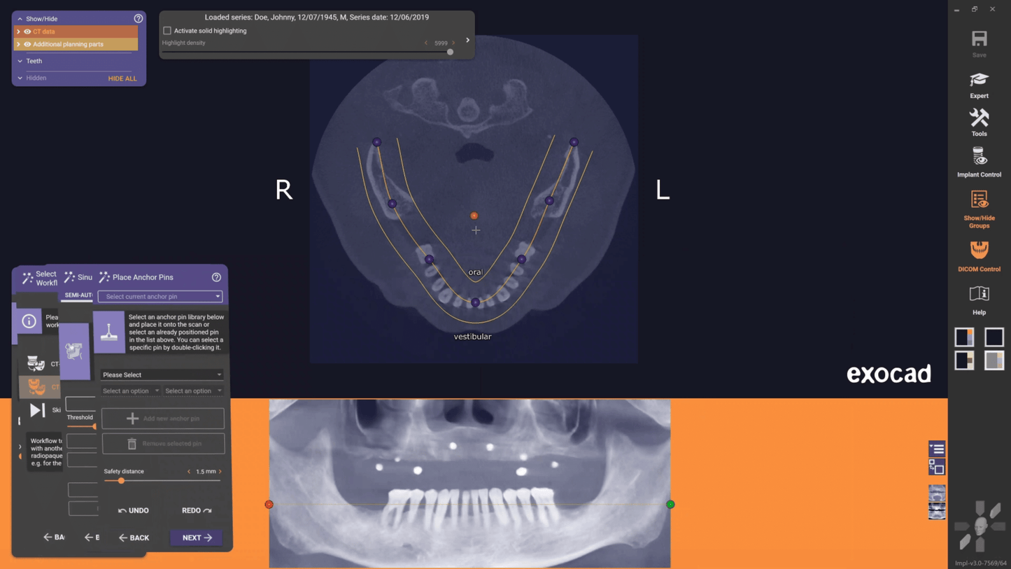 Exocad 9036 AI + partialCad 3.2 gratuit