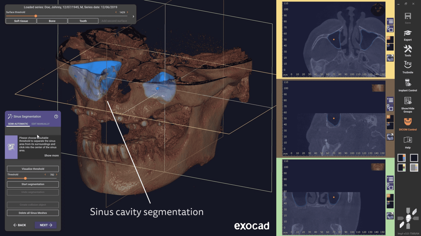 Exocad 9036 AI + partialCad 3.2 gratuit