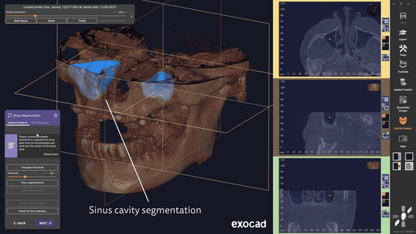 Exocad 9036 AI + partialCad 3.2 gratuit
